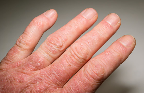 Psoriatická artritída